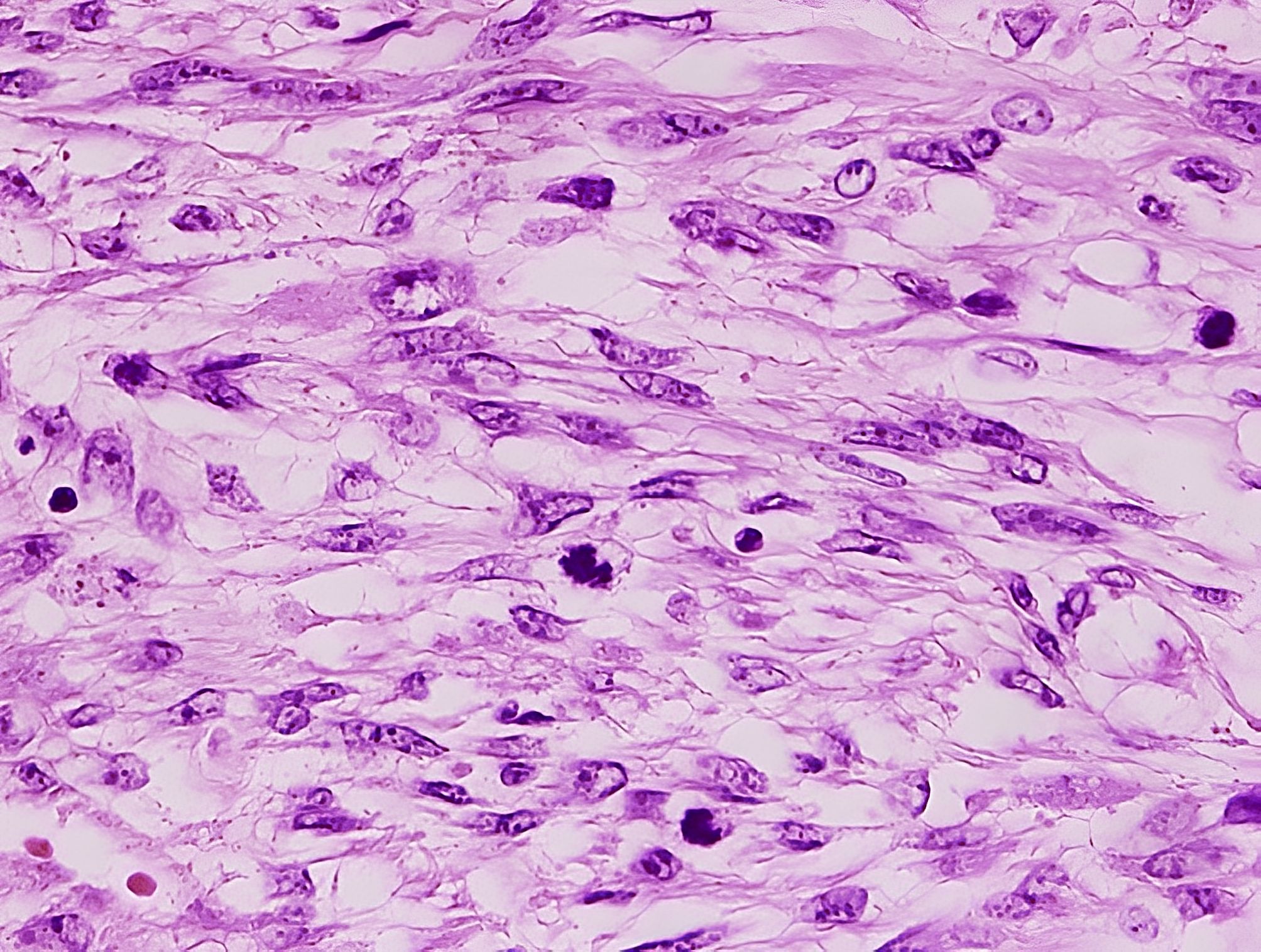 Leiomyosarkom Uterus
